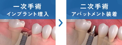 一次手術：インプラント埋入→二次手術：アバットメント装着